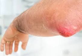 boils ,boils symptoms, boils causes, boils treatment, boil prevention, skin boils, boil infection, recurring boils, infected boils, boils on skin, boil home remedies, boils treatment at home, causes of boils, symptoms of boils, types of boils, bacterial skin infection, skin abscess, painful skin boils, recurring skin boils, boil diagnosis, boil prevention tips, boil healing, infected hair follicle, boil treatment options, boil symptoms and causes, best treatment for boils