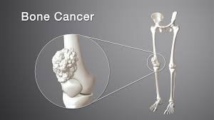 bone cancer, bone cancer symptoms, bone cancer causes, bone cancer treatment, bone cancer stages, bone cancer survival rate, bone cancer pain, is bone cancer deadly, types of bone cancer, osteosarcoma, chondrosarcoma, ewing sarcoma, bone cancer early signs, bone cancer diagnosis, bone cancer prevention, bone cancer risk factors, bone tumor, bone cancer therapy, chemotherapy for bone cancer, radiation therapy bone cancer, bone cancer recovery, bone cancer prognosis, bone cancer in children, bone cancer in adults, metastatic bone cancer, primary bone cancer, bone cancer awareness