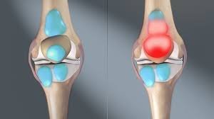 bursitis , how i cured my bursitis, bursitis treatment, causes of bursitis, bursitis symptoms, bursitis hip, how is bursitis diagnosed, bursitis shoulder, is bursitis painful,